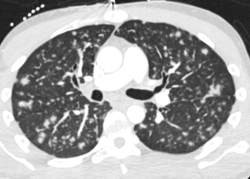 FIgure 1 CT scan